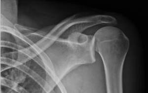 La série noire continue...